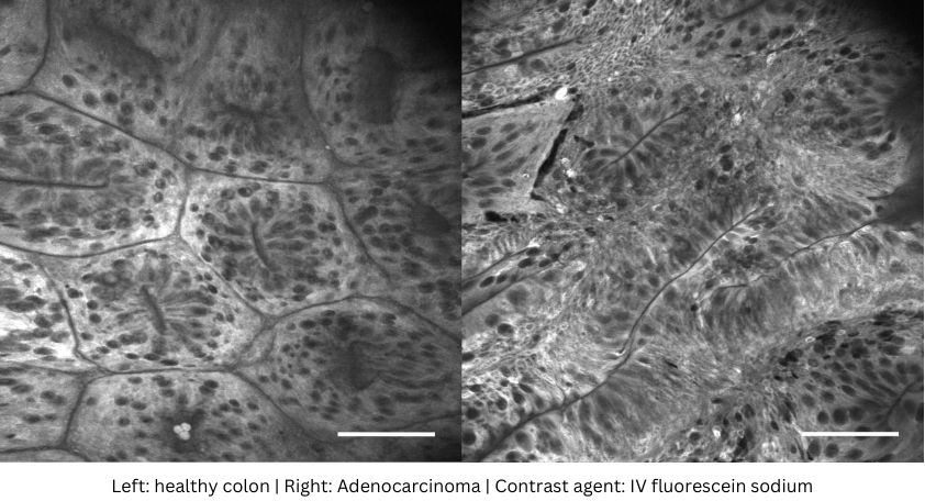 Optiscan Imaging_Colon Adenocarcinoma